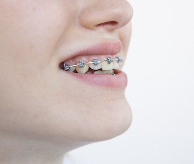 歯列矯正中の歯